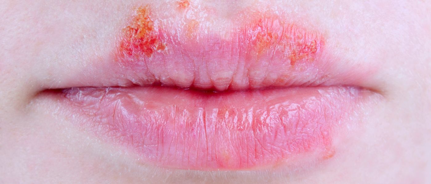 Herpes im mund weg geht wann Herpesauslöser: Gründe,